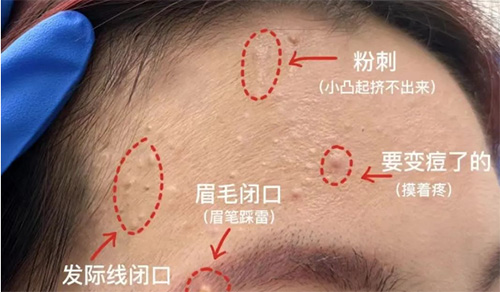 臉上經(jīng)常長閉口粉刺的原因有哪些？