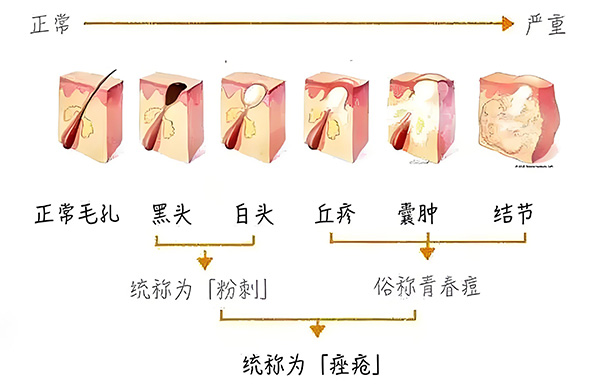 黑頭怎么去除最有效？去除黑頭最有效的方法