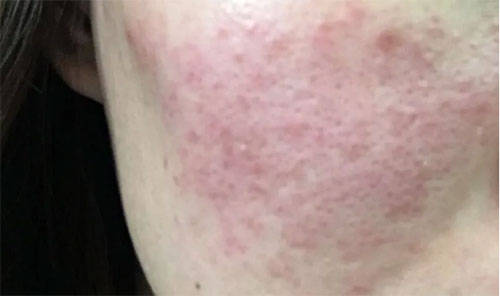 皮膚泛紅癢是什么原因？皮膚紅癢怎么回事？