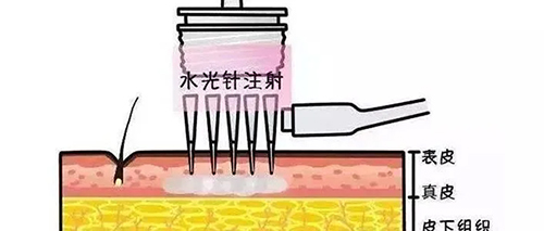 水光針的類型有哪幾種？