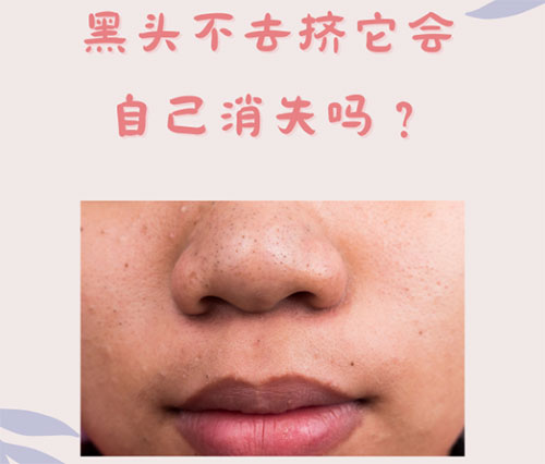 什么是黑頭？怎樣預防黑頭的形成？